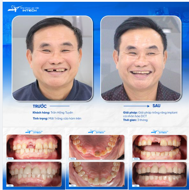 CẢI THIỆN THẨM MỸ HOÀN HẢO TRONG TRƯỜNG HỢP MẤT RĂNG CỬA VỚI GIẢI PHÁP TRỒNG RĂNG DCT