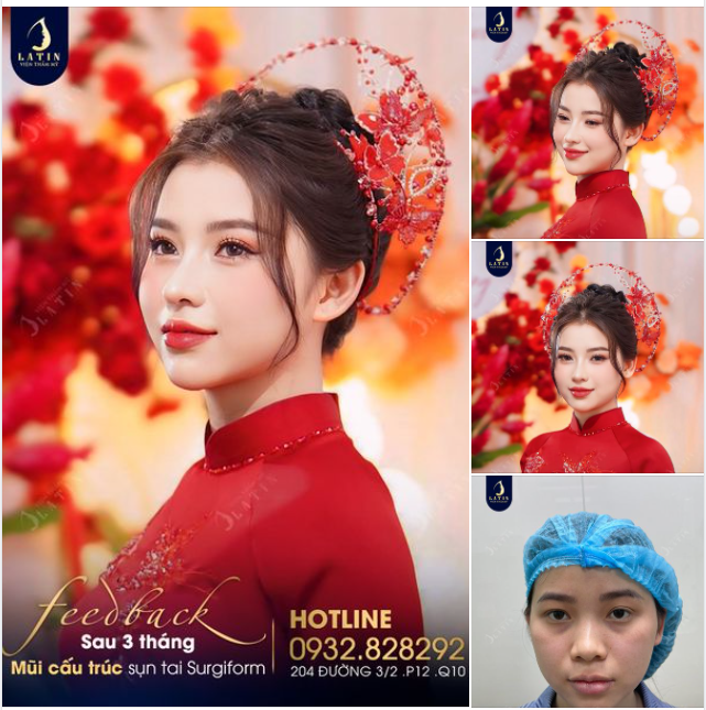 Đầu tuần nhả vía cô dâu xinh đẹp nhà Latin. Nâng mũi xong thay nhan sắc, cuộc đời thêm viên mãn.
