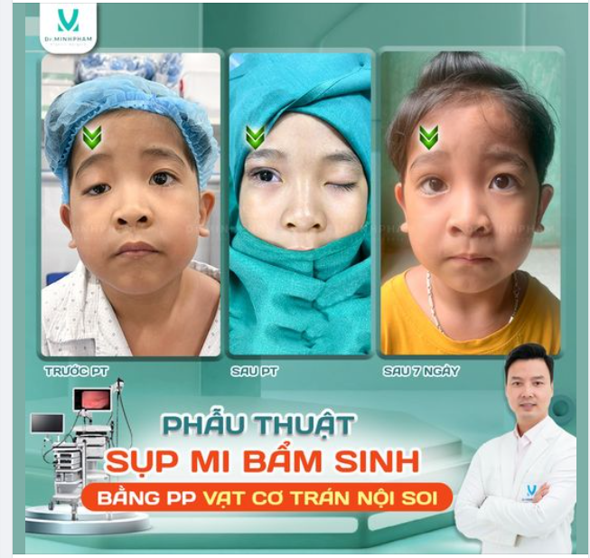 Sự Thay Đổi Diệu Kỳ Sau 7 Ngày Phẫu Thuật Sụp Mi Tại Dr. Minh Phạm