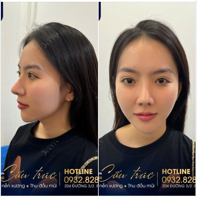 Em gái xinh đẹp sau 2 năm nâng mũi cấu trúc tại Latin