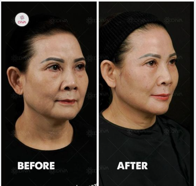 KHI U60 TIÊM 16CC FILLER MD CODES TRẺ HÓA SẼ NHƯ THẾ NÀO?