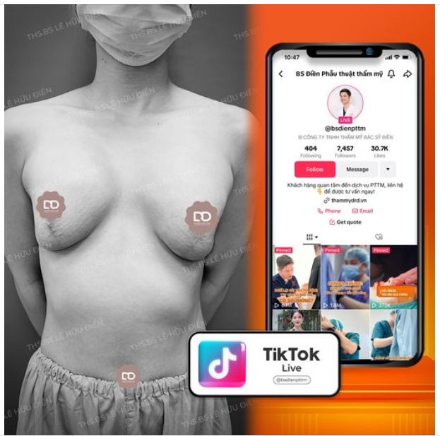 CA PHẪU THUẬT NÂNG V1 HÔM NAY CÓ GÌ ĐẶC BIỆT?