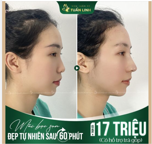 Trọn gói 17TR  Có ngay mũi đẹp thanh tú. Phương pháp: Nâng mũi bọc sụn tai