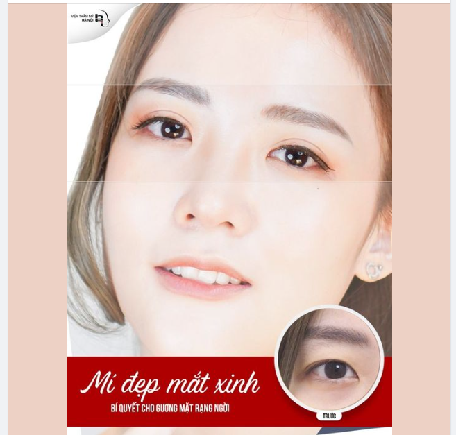NHẤN MÍ OVAL LINE WIDE DEEP - MÍ ĐẸP MẮT XINH