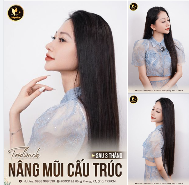 GẶP LẠI "HOTGIRL NGÀNH TRUYỀN THÔNG" SAU 3 THÁNG NÂNG MŨI CẤU TRÚC - SỬA LẠI DÁNG MŨI CHƯA ƯNG Ý