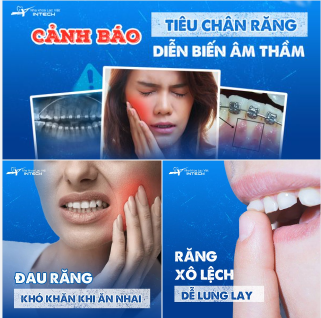CẢNH BÁO: TIÊU CHÂN RĂNG DIỄN BIẾN ÂM THẦM, CẦN ĐỀ PHÒNG BIẾN CHỨNG