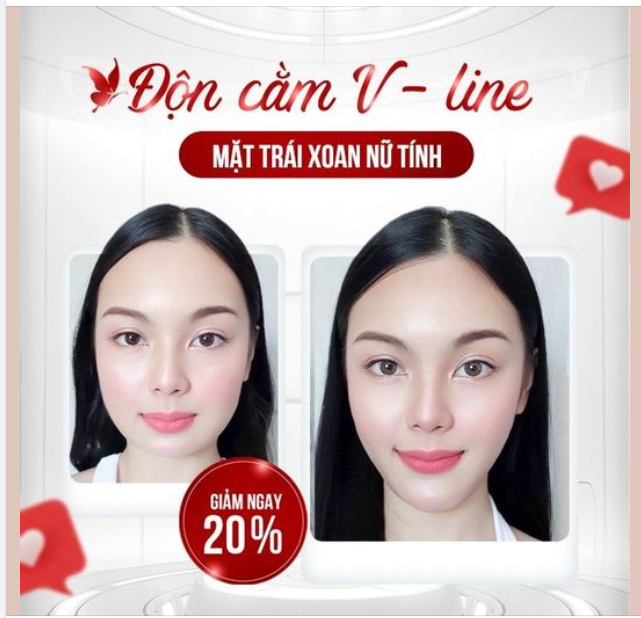 ĐỘN CẰM VLINE kiến tạo MẶT TRÁI XOAN NỮ TÍNH XINH ĐẸP