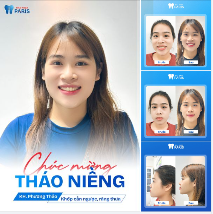 KHỚP CẮN NGƯỢC ĐẾN ĐÂU - ĐỀU ĐẸP NHANH ĐẾN ĐẤY