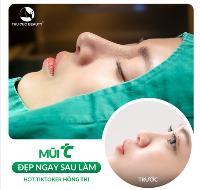 So sánh kết quả trước và ngay sau nâng mũi của Hot Tiktoker Hồng Thi