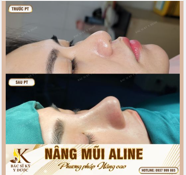 NÂNG MŨI ALINE - PHƯƠNG PHÁP NÂNG CAO