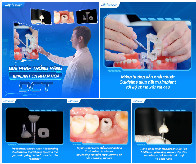 4 THÀNH PHẦN QUAN TRỌNG NHẤT TRONG GIẢI PHÁP TRỒNG RĂNG IMPLANT CÁ NHÂN HÓA DCT