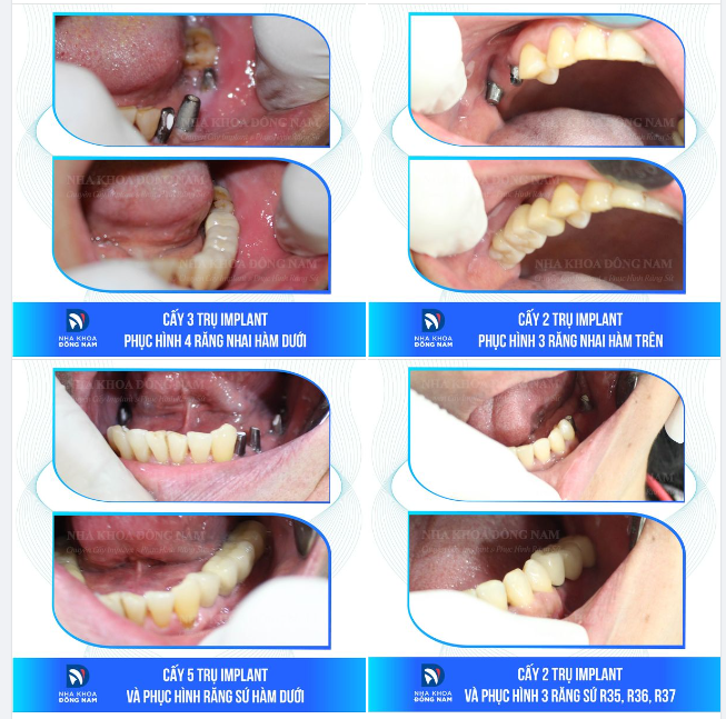 Tìm lại niềm vui ăn uống sau trồng răng implant răng hàm 