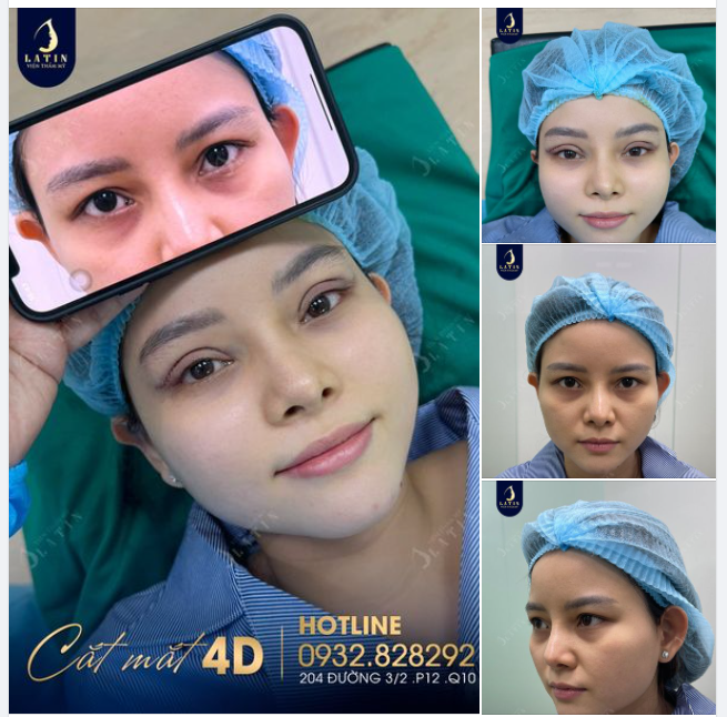 Mí 4D cho chị gái thích nếp mí to tròn. Mắt sụp mí, da thừa nhiều khiến cho đôi mắt chị thiếu tươi tắn.