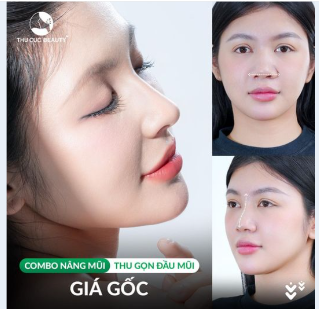 Combo Nâng mũi + Thu gọn đầu mũi GIÁ GỐC Duy nhất tại bài viết này