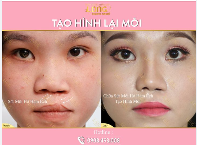 XÓA BỎ KHUYẾT ĐIỂM - TẠO HÌNH MÔI XINH