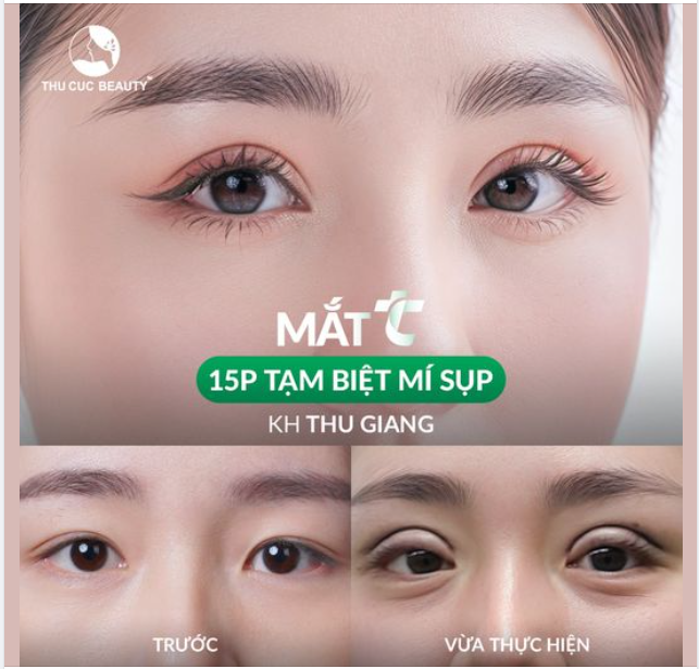 Thường xuyên phải sử dụng miếng dán kích mí mỗi ngày để có nếp mí cân đều