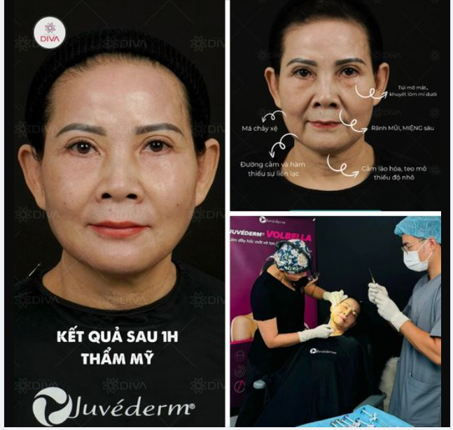 Filler MD Codes chính là phương pháp làm đẹp được gọi tên.