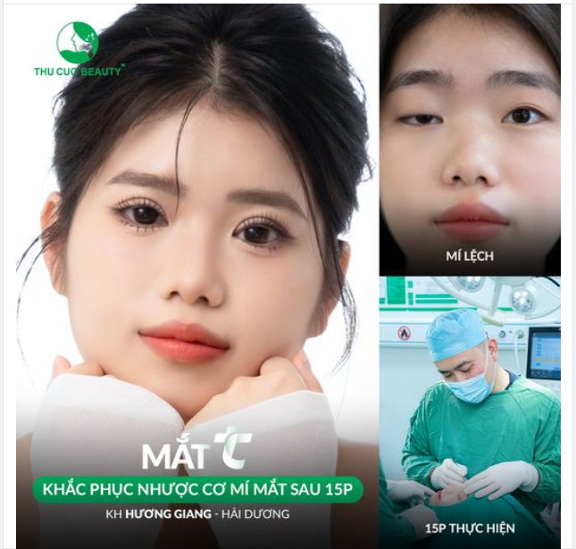 Nhược cơ mí mắt gây mất thẩm mỹ, ảnh hưởng tầm nhìn?