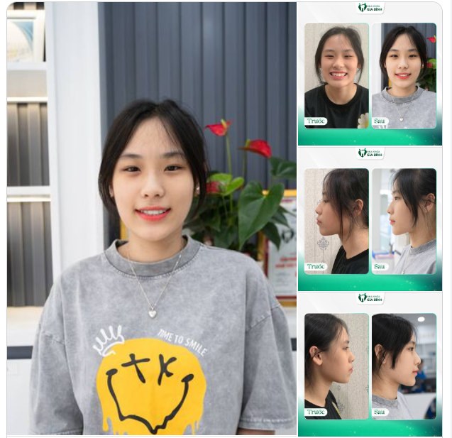 NỐT NHẠC CỦA TUỔI XUÂN ĐÃ ĐƯỢC HOÀN THIỆN SAU KHI NIỀNG RĂNG