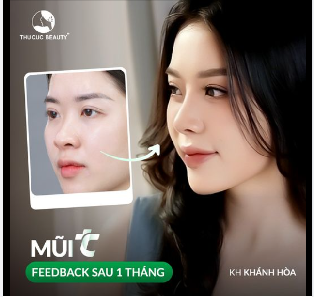 Hình ảnh feedback chân thực sau 1 tháng nâng mũi từ Hot girl Khánh Hòa