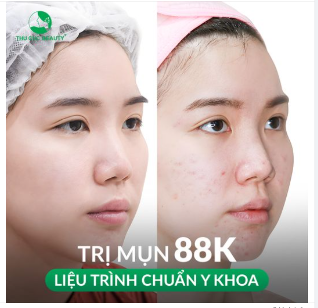 Liệu trình trị mụn chuẩn y khoa chỉ 88k