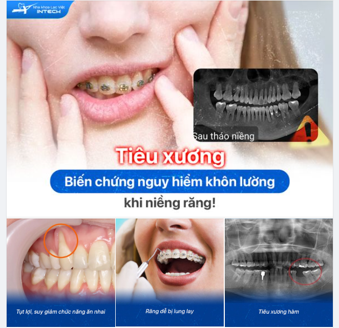 TIÊU XƯƠNG KHI NIỀNG RĂNG: BIẾN CHỨNG KHÔNG THỂ XEM THƯỜNG!