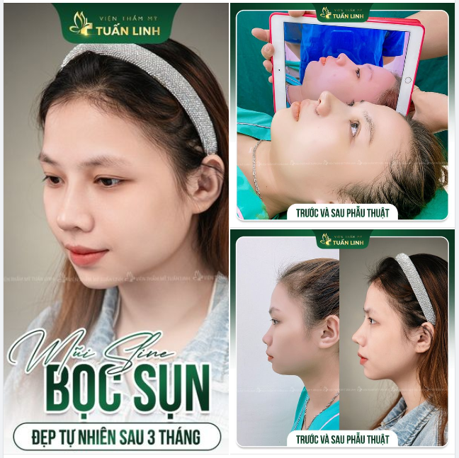 CẬN CẢNH DÁNG MŨI SAU 3 THÁNG TÁI KHÁM!!