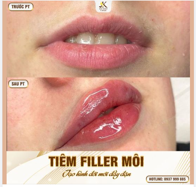 Tiêm Filler Môi - Tạo hình môi căng mọng