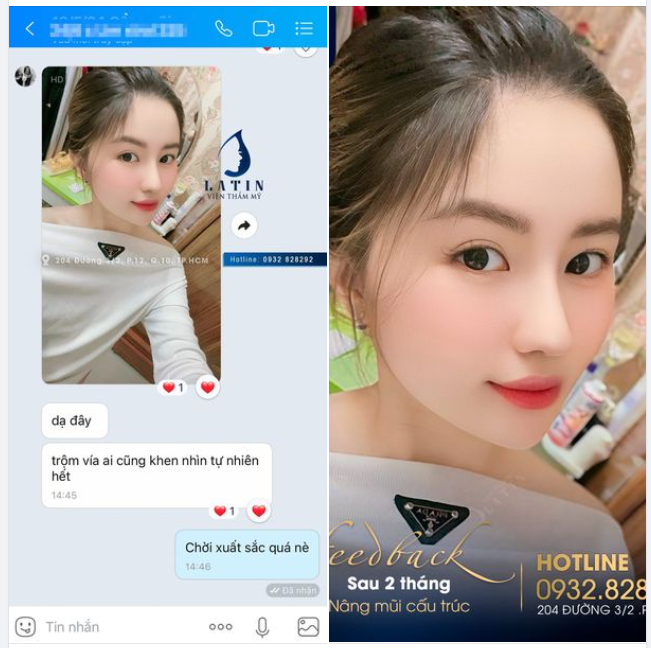 Xinh như hotgirl sau 2 tháng nâng mũi tại Latin. Mũi này cả nhà chấm mấy điểm đây ạ