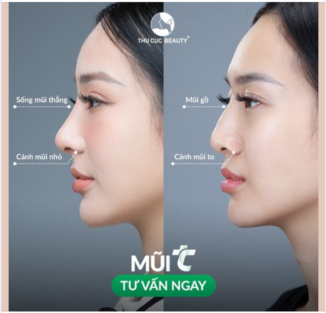 Nhận lại kết quả đẹp mỹ mãn ngay chỉ sau 30P nâng mũi
