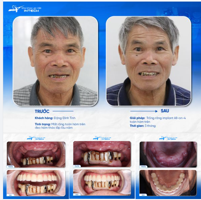 TÌM LẠI CẢM GIÁC NGON MIỆNG, KHÔI PHỤC HÀM RĂNG MẤT CHỈ SAU 2 LẦN HẸN