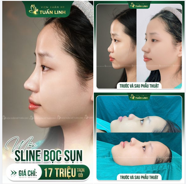 Nâng mũi bọc sụn dáng mũi Sline