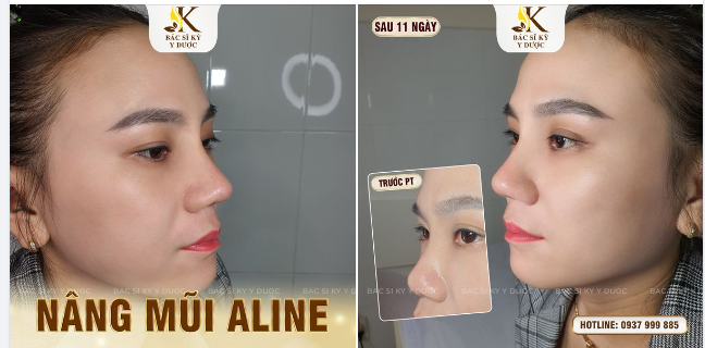 VẪN LÀ DÁNG MŨI ALINE MÀ RẤT NHIỀU CHỊ EM YÊU THÍCH
