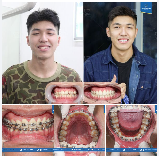 Tháo niềng sớm, chúc Ngọc Anh đạt được ước mơ trở thành Tiếp viên hàng không trong tương lai gần