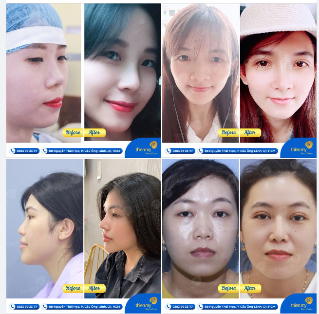 Hành trình nâng mũi tại PKCK Thiện Mỹ