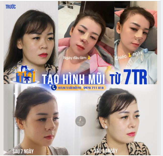 Hành trình 14 ngày để có mũi đẹp!!!  Mừng sinh nhật PTTM Dr Trí, ƯU ĐÃI THẢ GA cho nhiều dịch vụ: