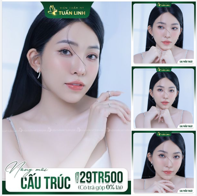 Nhan sắc xinh đẹp của khách hàng sau nâng mũi