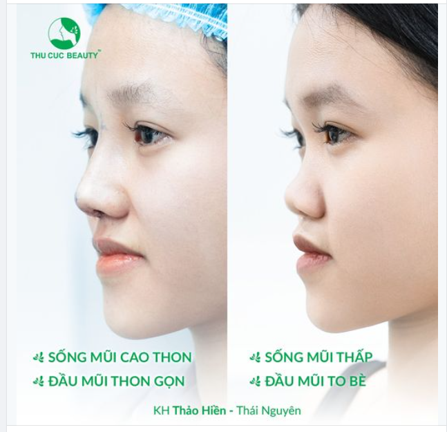Kết quả sau 30P nâng mũi của khách hàng 2K3