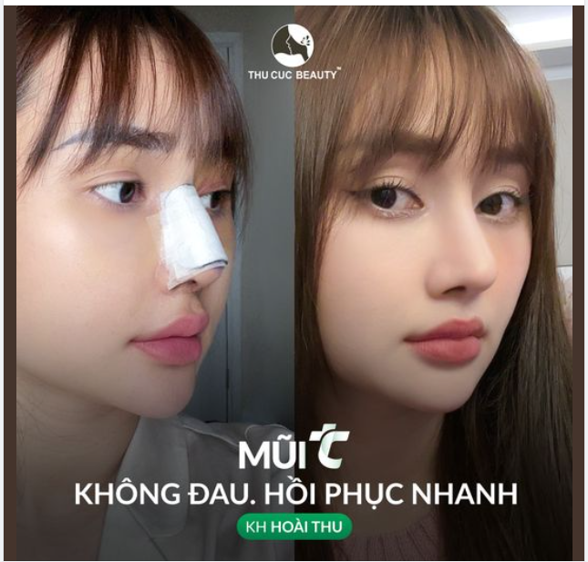 Chân ái dành riêng cho các chị em muốn sở hữu dáng mũi cao