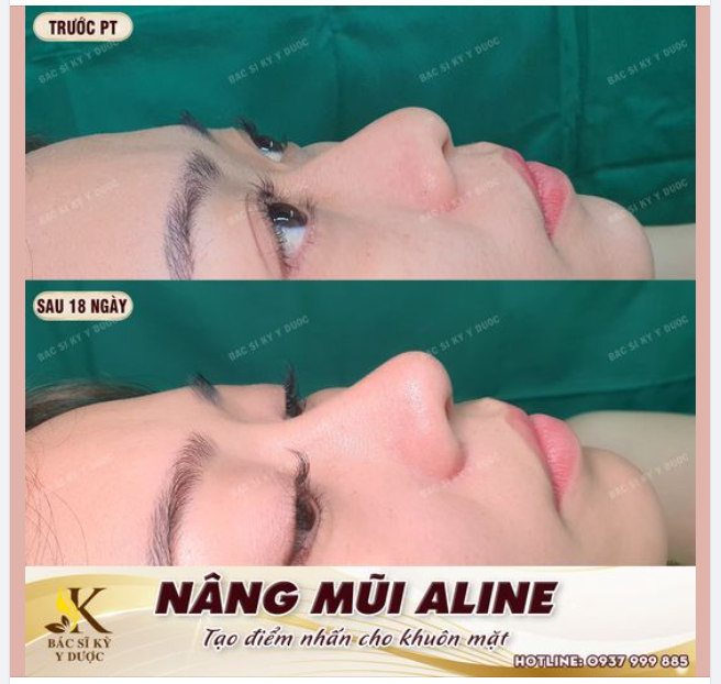 NÂNG MŨI ALINE -”KIẾN TẠO” THẦN THÁI