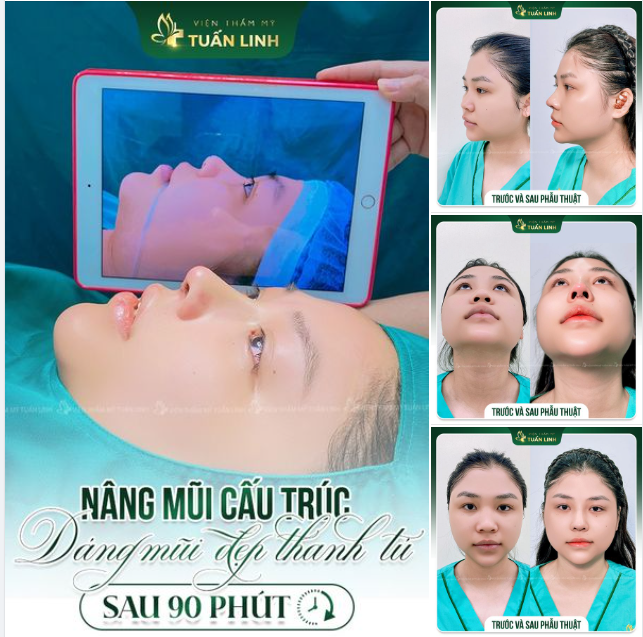 Sở hữu ngay dáng mũi cực phẩm sau 90 phút thực hiện.