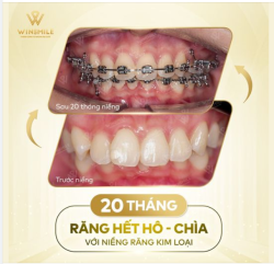 NIỀNG RĂNG THỜI ĐIỂM VÀNG, CHO CON SẴN SÀNG CƯỜI XINH