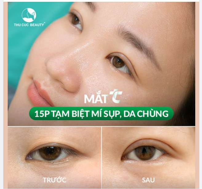 Mí sụp, da chùng khiến đôi mắt lờ đờ, thiếu sức sống