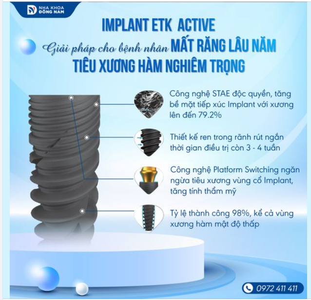 Implant ETK Active: Giải pháp hoàn hảo cho mọi tình trạng mất răng