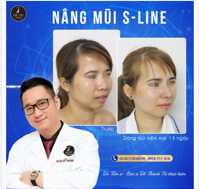 Xong 14 ngày chăm sóc hậu phẫu tỉ mỉ - cẩn thận Dáng mũi SLine cho cô gái thích tự nhiên