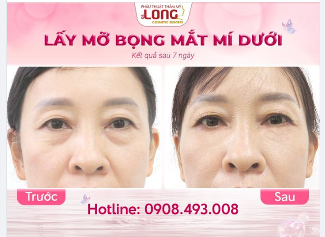 LẤY MỠ BỌNG MẮT NHƯ THẾ NÀO MỚI GỌI LÀ “THÀNH CÔNG”?