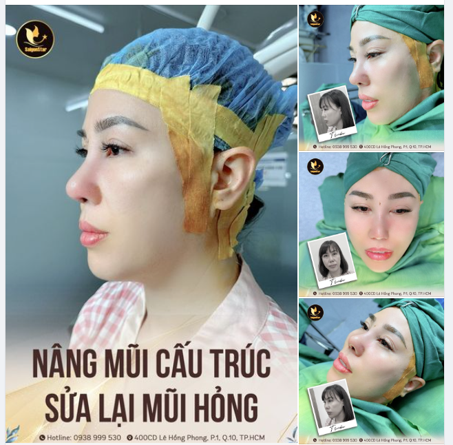 GIẢI CỨU MŨI HỎNG - TÁI TẠO DÁNG MŨI ĐẸP TỰ NHIÊN