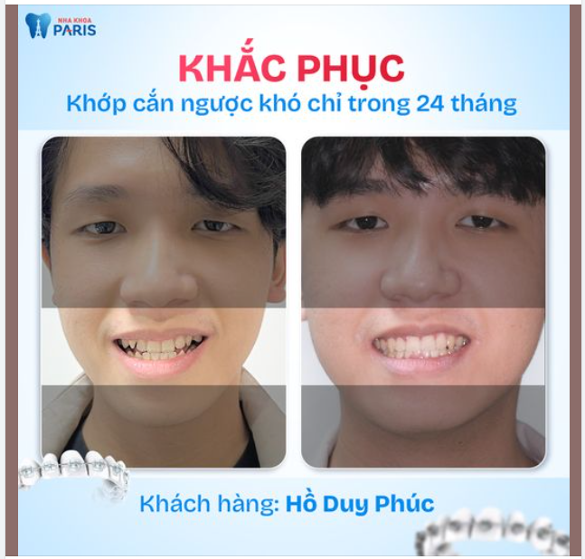 CẢI THIỆN CUNG RĂNG TRÒN ĐỀU CHỈ SAU 24 THÁNG NIỀNG