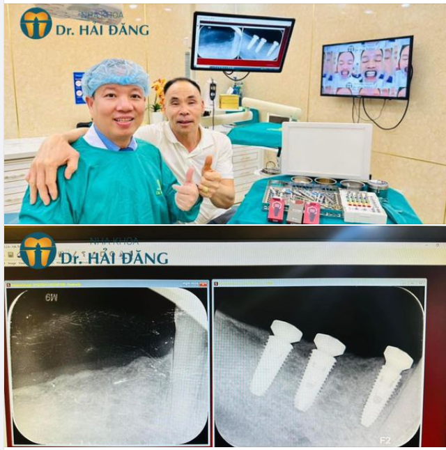 TRỒNG RĂNG IMPLNAT THAY THẾ RĂNG ĐÃ MẤT