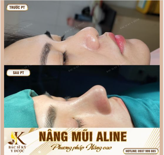 "ĐỘ" DÁNG MŨI MỚI ĐỂ XINH ĐẸP VÀ TỰ TIN HƠN